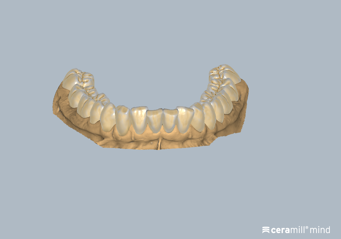 Videoschulung: Ceramill M-Splint – Anatomische Schiene