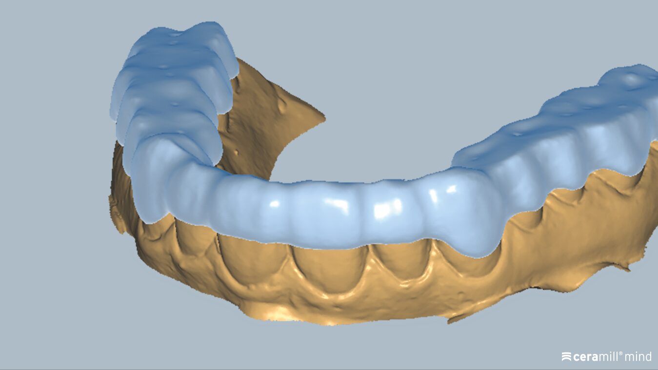 Videoschulung: Ceramill M-Splint &#8211; Aufbissschiene