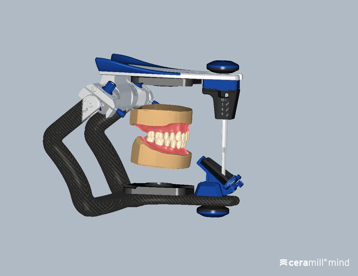 Ceramill Mind: Totalprothetik – Ceramill FDS