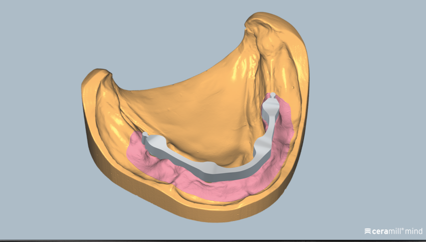 Videoschulung: Ceramill M-Bars