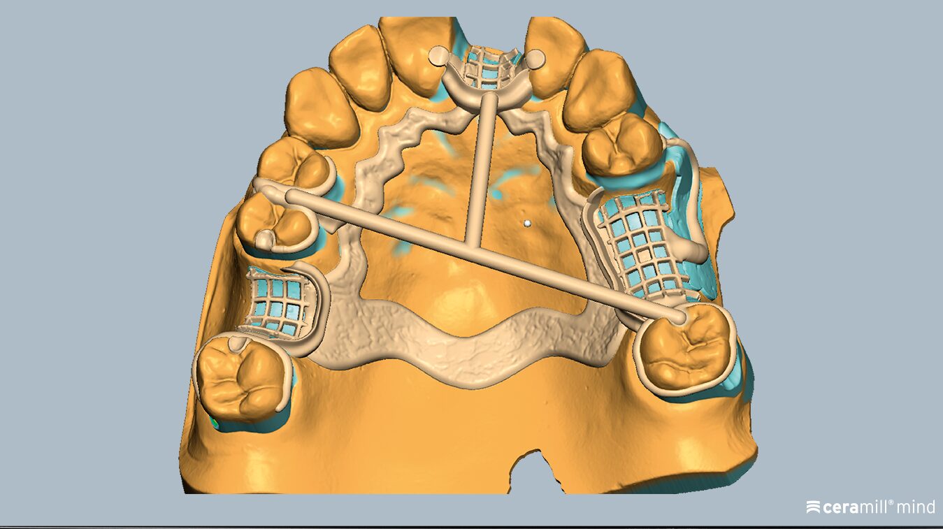 Videoschulung: Ceramill M-Part