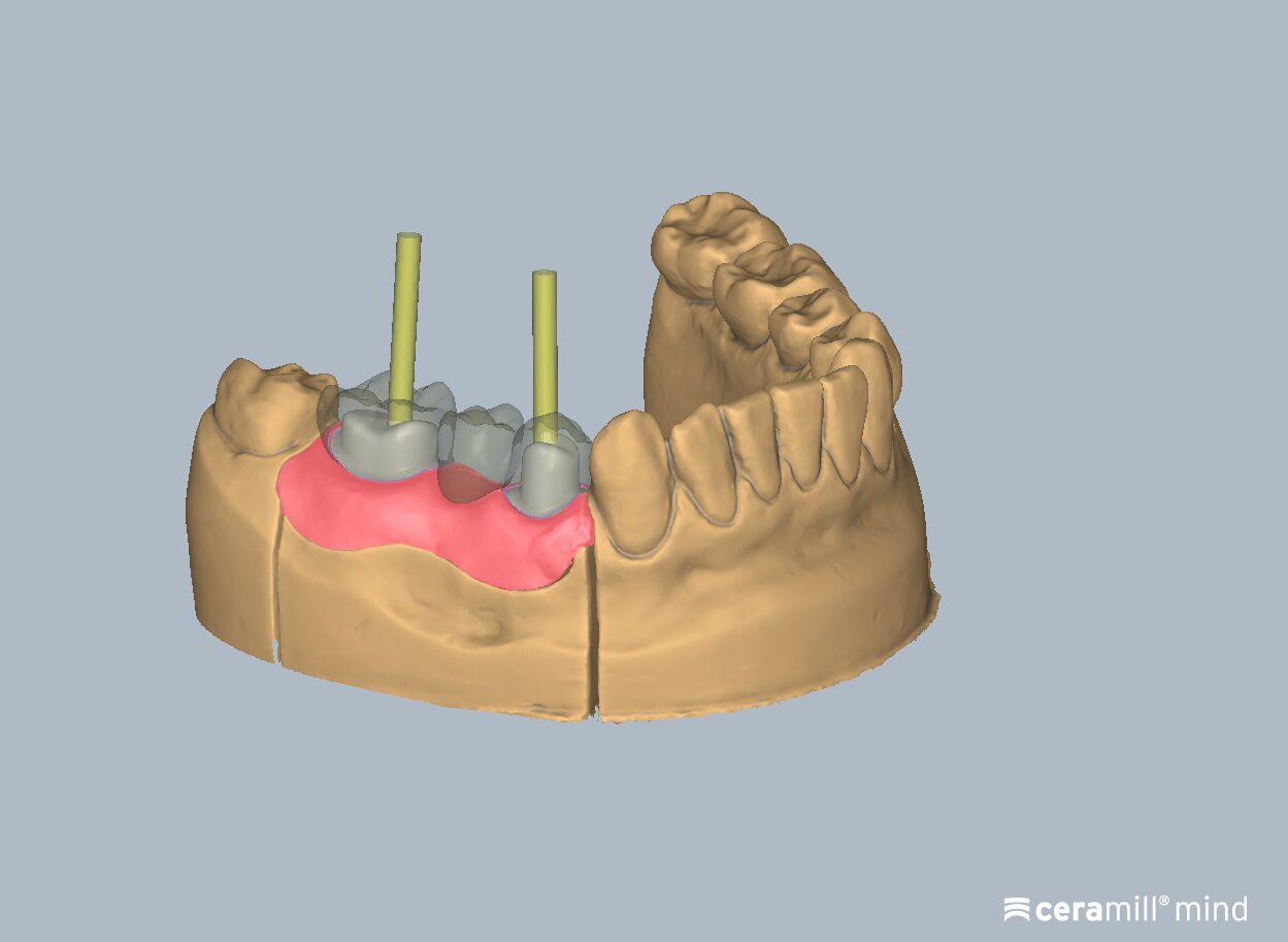 Ceramill Mind: Ceramill M-Plant