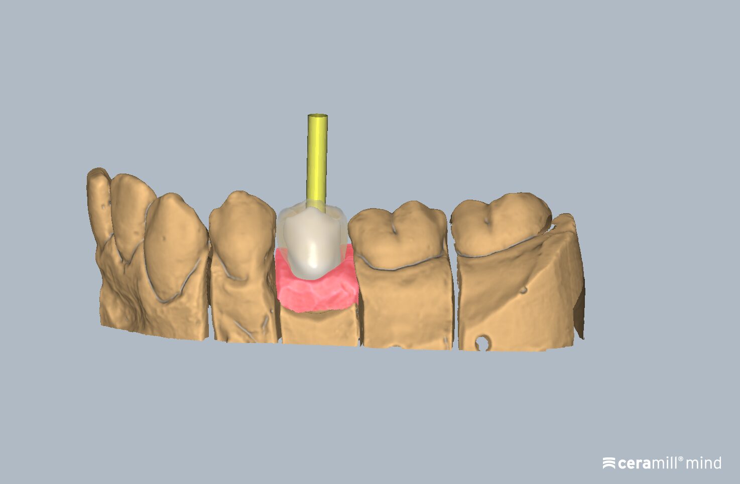 Ceramill Mind: Ceramill DRS M-Plant