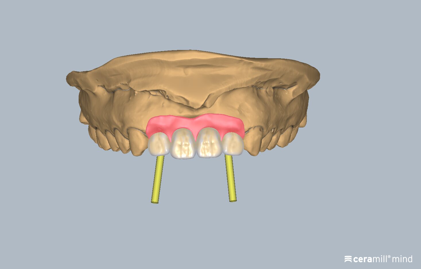 Ceramill Mind: Ceramill M-Gin