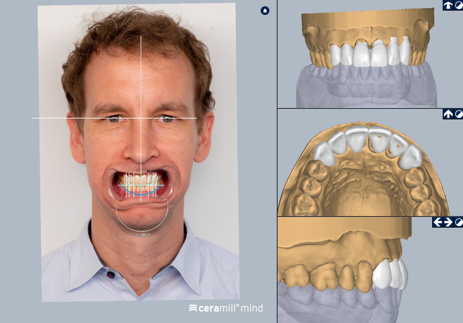 Ceramill Mind: Ceramill M-Smile